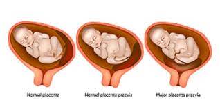 Placenta Praevia Low Lying Placenta Nct