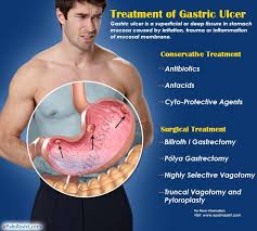 Browse 1,114 stomach ulcer stock photos and images available, or search for stomach pain or peptic ulcer to find more great stock photos and pictures. Treatment Of Gastric Ulcer