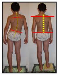 Image result for Functional Leg Length Discrepancy