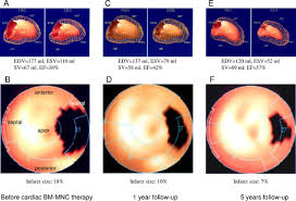 Noemi young is available for pay shootings. Long Term Outcome Of Combined Percutaneous Intramyocardial And Intracoronary Application Of Autologous Bone Marrow Mononuclear Cells Post Myocardial Infarction The 5 Year Mystar Study