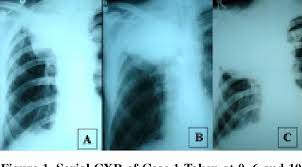 Tuberculosis (tb) infection is caused by a bacteria called mycobacterium tuberculosis. Pdf A Common Medical Error Lung Cancer Misdiagnosed As Sputum Negative Tuberculosis Semantic Scholar