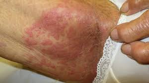 Image result for sore skin in the groin area