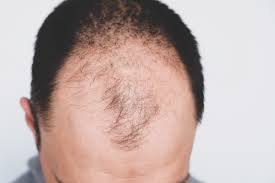 Our hair is so related: Male Pattern Baldness Embarrassing Problems