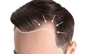 sac dokulmesi neden olur sac dokulmesini onlemek icin beslenme ve tedavi onerileri