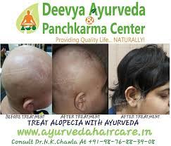 In some cases with internal or hormonal problems, alone mahabhringraj oil may have little effects. Articles Alopecia Universalis Treatment In Ayurveda For Deevya Ayurveda Panchkarma Center