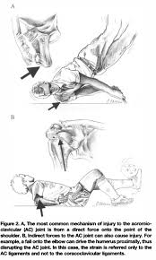 If the ligaments in the ac joint are torn, the condition is more severe (grade 2). Ac Joint Vasta Performance Training And Physical Therapy