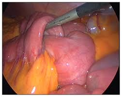 Image result for Intussusception