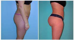 Avec le lipofilling, la graisse peut être utilisée pour avec le lipofilling (=lipotransfert), la graisse est prélevée sur le corps du patient et utilisée pour combler les rides, plis et creux situés ailleurs. Augmentation Fesses Maroc Prix Lipofilling Fessier Pas Cher