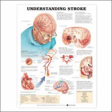 details about understanding stroke neurology anatomy poster anatomical chart company