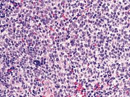Cancer cells from an mcc tumor can break off and go into the lymphatic system or the blood. Pathology Outlines Ewing Sarcoma Pnet