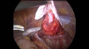 Using a laparoscope — a slim, lighted instrument inserted into your abdomen through a small incision — your doctor can see your ovaries and remove the ovarian cyst. Laparoscopic Removal Of Ovarian Cyst Full Hd Video Youtube