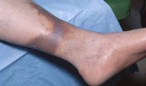 Image result for Lipodermatosclerosis