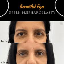 Cosmetic Upper Eyelid Surgery (Blepharoplasty)