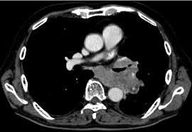 Doctors can use a ct scan to look for lung cancer. Chest Ct Scan At The Time Of Diagnosis Of Small Cell Lung Cancer Download Scientific Diagram
