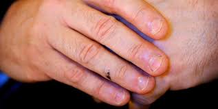 Und zwar habe ich mir irgendwann eine kleine schnittwunde am finger zugezogen. Blutvergiftung Durch Nagelkauen Schuttelfrost Fieber Familienvater Fast Gestorben Weil Er Nur Eine Grippe Vermutete Mz De