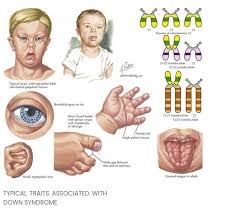According to the statistics, approximately 10% of people have the. Down S Syndrome Overview Symptoms And Diagnosis Blog Hubblog Hub