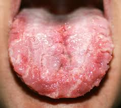 Image result for white cancer on tongue)