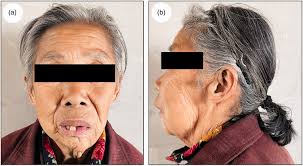 Pathogenesis and characteristics of large ameloblastoma of the jaw: a  report of two rare cases