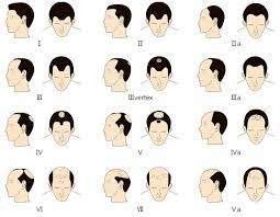 Heute werde ich ihnen zeigen eine sehr stilvolle frisuren männer geheimratsecken für 2019. Frisuren Mit Geheimratsecken Fur Manner 12 Gute Varianten Fur Frisur