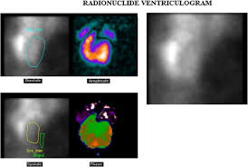 Image result for Nuclear Ventriculogram