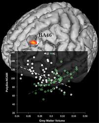 Learn about schizophrenia in the brain and the schizophrenic brain itself. Brain Structure Cognition And Negative Symptoms In Schizophrenia Are Associated With Serum Levels Of Polysialic Acid Modified Ncam Translational Psychiatry