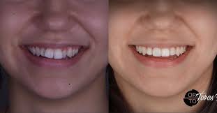 7 ayda şeffaf plaklarla, diş çekmeden güzel ve doğal bir gülüş yarattık.  Tedavimiz hala devam ediyor ama şimdiden rahatça gülebiliyoruz. Yıllarca  beklemenize gerek yok, gülüşünüzü ertelemeyin. Çünkü…