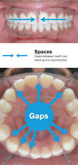 Having wide spaces between the teeth is often a genetic trait and many people like their gap and feel that it gives their smile character. Gaps Between Teeth Before And After Braces Viechnicki Orthodontics