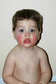 Slideshow get help for migraine relief. Rashes In Children Children S Health Issues Msd Manual Consumer Version