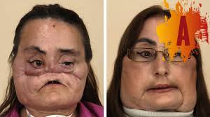 First up is face transplant. 10 Before And After Face Transplant Photos Youtube