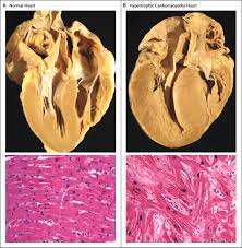 Image result for Cardiomyopathy