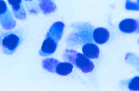 Image result for Chlamydia Trachomatis