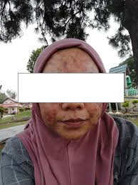 She specialises in the diagnosis and treatment of conditions that may affect the skin, hair and nails. Dr Ko Skin Specialist Review Frustrating Updated Crack Culture