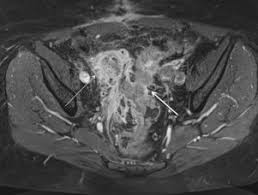Abdominal pain, bloating, and other symptoms can occur, but may be mistaken for other conditions. Digestive Diseases Mimicking Primary Gynecological Diseases Or With Secondary Gynecological Manifestations Sciencedirect