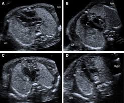 Reference Ranges For The Size Of The Fetal Cardiac Outflow