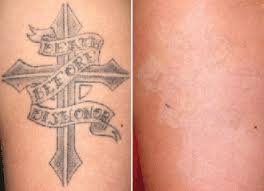 Renew medspa brings advanced laser tattoo removal, pigmented lesion removal, vascular lesion removal, and more to detroit lakes, mn featuring the astanza duality laser. Lasers Make Their Marks On Skin And Tissue Procedures Features Aug 2015 Biophotonics