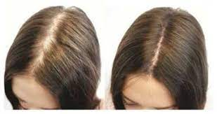 Fluoride & hair loss originally posted by ylva the finnish thl website (healthcare institute) clearly states that when the fluoride concentration of drinking water surpasses 1,5 mg/l, the negative effects become a lot more common. Pin On Nuskin Ap24 Whitening Fluoride Toothpaste Authentic 110g 4oz New