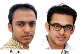 Read actual customer experiences before you choose! Are Richfeel Treatments For Hair Fall Actually Effective Quora