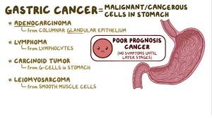 The main symptoms and syndromes in diseases of the stomach and intestine. Gastric Cancer Osmosis