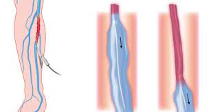 Endovenous Laser Treatment For Varicose Veins