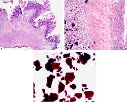 Image result for Kayexalate