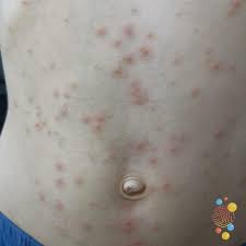 Image result for Deep Folliculitis
