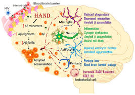 Image result for AIDS Dementia Complex