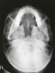 Image result for Skull XRay