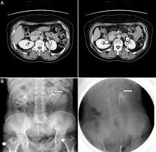 It has a mucous membrane and is covered with transitional epithelium and an underlying lamina propria of. A A Fibroepithelial Polyp In The Left Renal Pelvis In A 55 Year Old Download Scientific Diagram