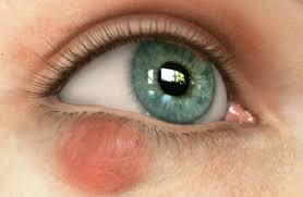 как лечить ячмень на нижнем веке в домашних условиях Halyazion Verhnego Ili Nizhnego Veka Lechenie V Domashnih Usloviyah