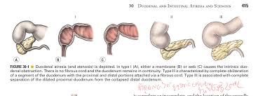 Image result for Intestinal Atresia