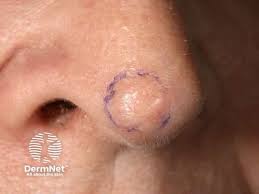 Image result for skin cancer on nose pimple