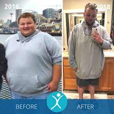 The connection between the stomach and the intestines narrows (stomal stenosis) 5% to 15% of the time, leading to nausea and vomiting after. Gastric Sleeve Before And After Photos The Best Pictures Of 2020