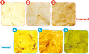 Image result for acholic stools human