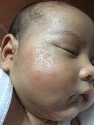 RASHES Ano po bang pwedeng ilagay sa rashes ni baby sa face?